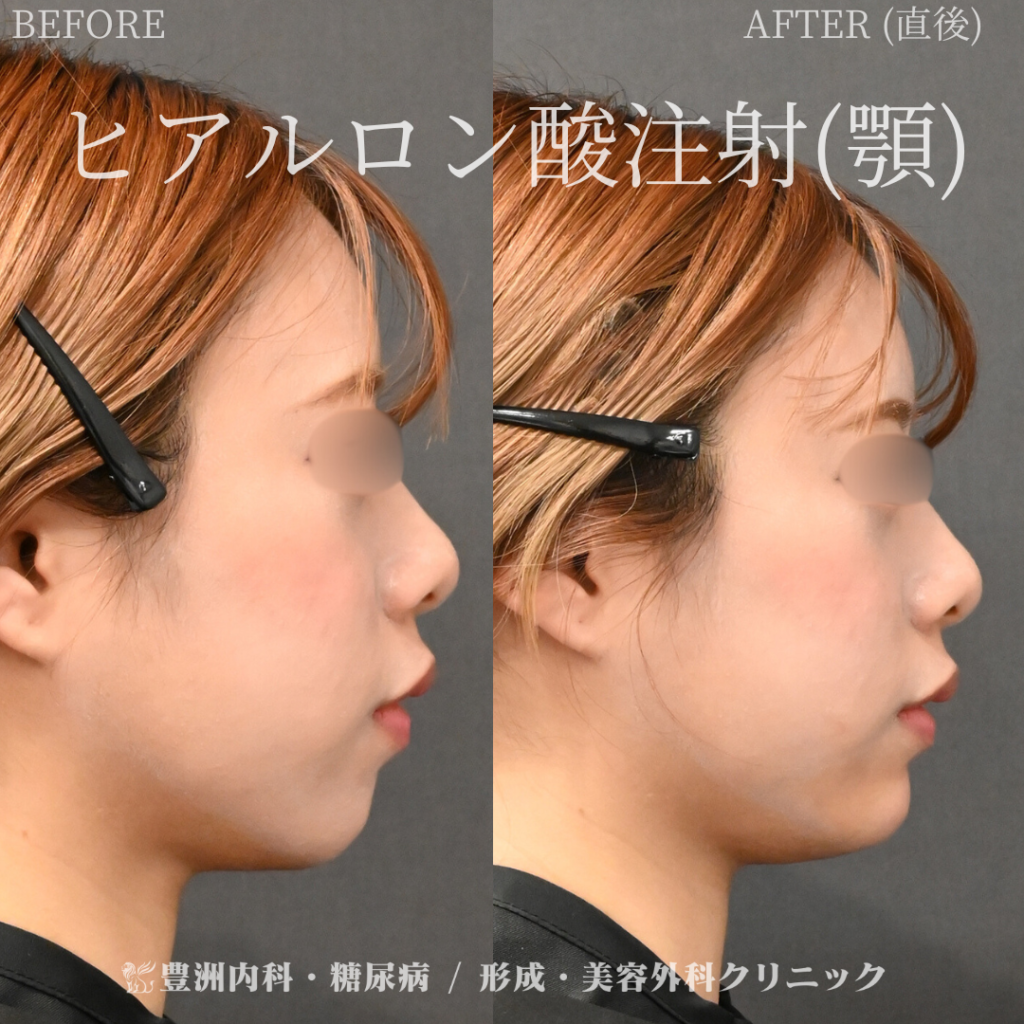 顎ヒアルロン酸 / 20代女性
